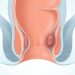 Hemorroides: qué son, cómo prevenirlas, sus síntomas y opciones de tratamiento