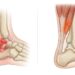 ¿Qué diferencia hay entre un esguince y una distensión muscular? Cómo reconocer y diferenciar cada tipo de lesión