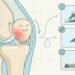¿Qué es la condromalacia rotuliana y cómo tratarla para aliviar el dolor de rodilla?