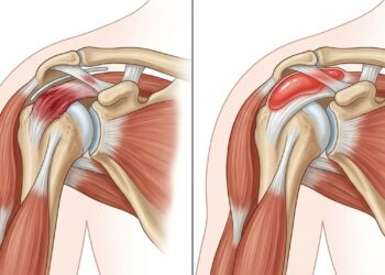 ¿Qué diferencia hay entre la tendinitis y la bursitis? Cómo reconocer y diferenciar cada tipo de dolor en el hombro