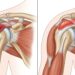 ¿Qué diferencia hay entre la tendinitis y la bursitis? Cómo reconocer y diferenciar cada tipo de dolor en el hombro