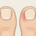 Cuántas veces por semana es normal cortarse las uñas para cuidar y proteger los pies