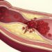Colesterol alto no tratado: factores, complicaciones de salud y su impacto en las arterias