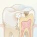 Cómo se forma la caries, cómo se detecta y cuál es su tratamiento
