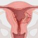 Cólicos menstruales: qué los causa y qué hacer cuando empieza el malestar