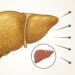 Pedir comida para llevar con frecuencia puede favorecer la acumulación de grasa hepática.