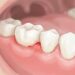 El sangrado frecuente al cepillarse puede ser una primera señal de gingivitis.