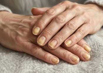 Uñas amarillas y las señales que debes vigilar