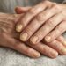 Uñas amarillas y las señales que debes vigilar