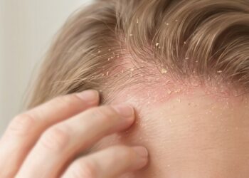 La dermatitis seborreica puede causar caspa, picor y descamación recurrente en la piel.