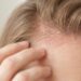 La dermatitis seborreica puede causar caspa, picor y descamación recurrente en la piel.