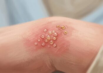 Ardor, hormigueo y ampollas agrupadas pueden indicar un brote de herpes en la piel.