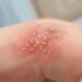 Ardor, hormigueo y ampollas agrupadas pueden indicar un brote de herpes en la piel.