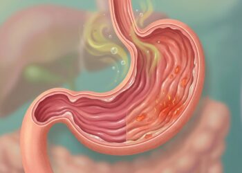 La gastritis inflama la mucosa gástrica y puede provocar ardor, náuseas y llenura.