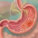 La gastritis inflama la mucosa gástrica y puede provocar ardor, náuseas y llenura.