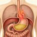 La hernia de hiato favorece el reflujo al alterar la barrera antirreflujo.