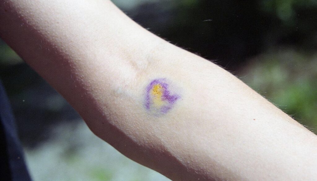 Estresse intenso pode causar manchas roxas e o corpo dá sinais importantes