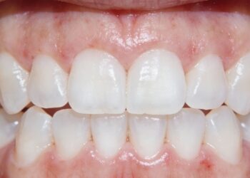 O que a gengiva inchada e vermelha está tentando avisar