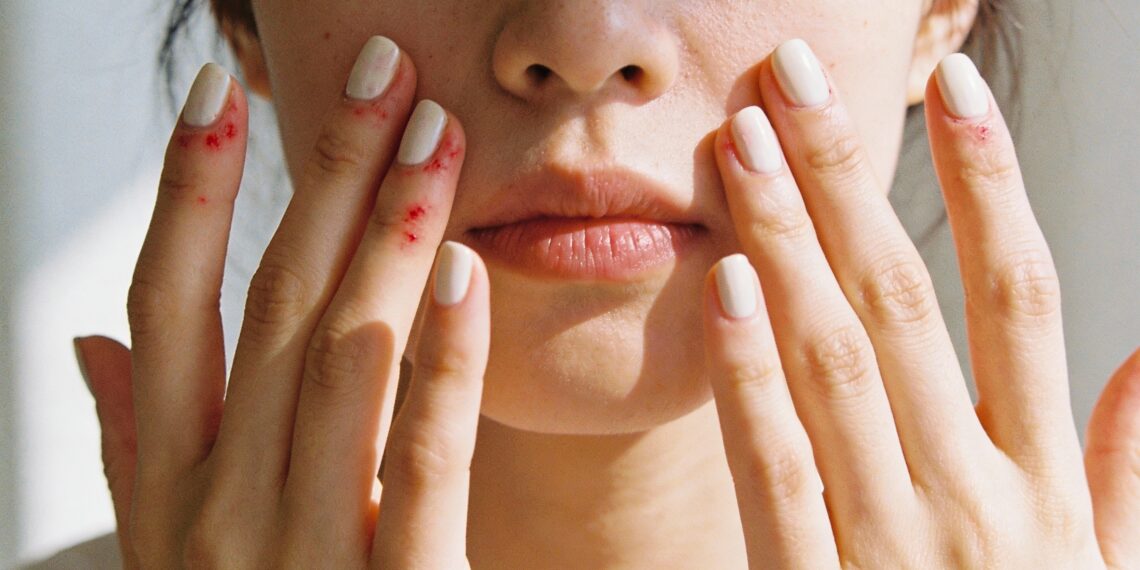 Coceira nas pálpebras e pescoço depois de pintar a unha pode ser alergia a esmalte