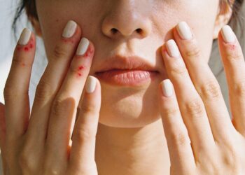 Coceira nas pálpebras e pescoço depois de pintar a unha pode ser alergia a esmalte