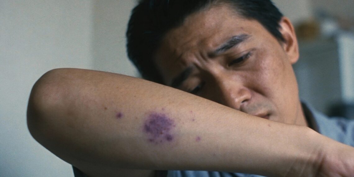 Estresse intenso pode causar manchas roxas e o corpo dá sinais importantes