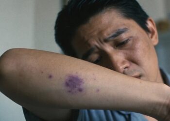 Estresse intenso pode causar manchas roxas e o corpo dá sinais importantes