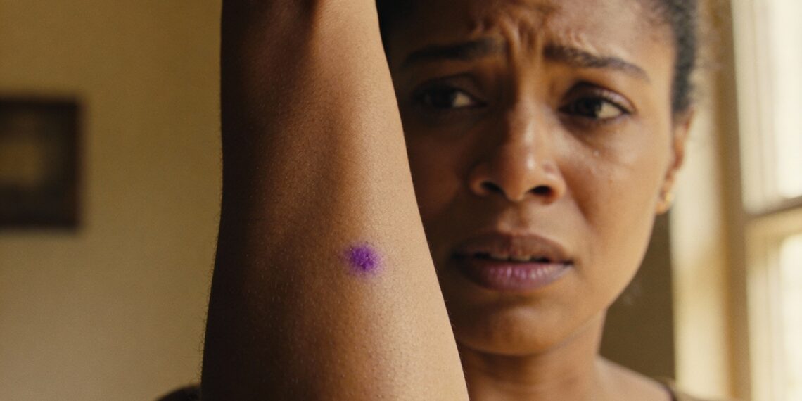 O estresse pode causar o aparecimento de manchas roxas na pele?