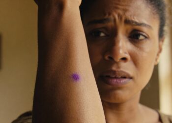 O estresse pode causar o aparecimento de manchas roxas na pele?