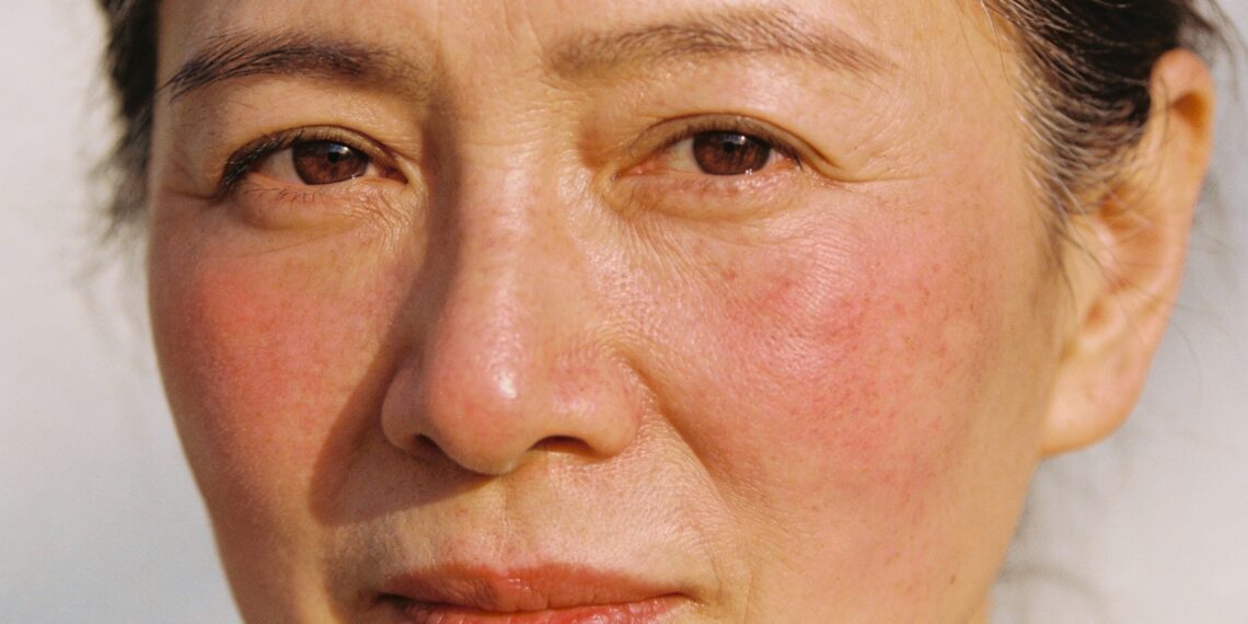 Se seu rosto fica vermelho do nada, esses podem ser os verdadeiros motivos