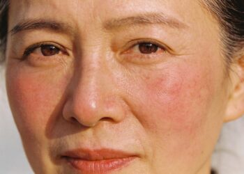 Se seu rosto fica vermelho do nada, esses podem ser os verdadeiros motivos