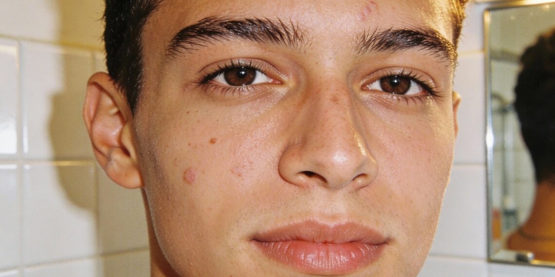 O que realmente ajuda a reduzir espinhas sem agredir a pele?