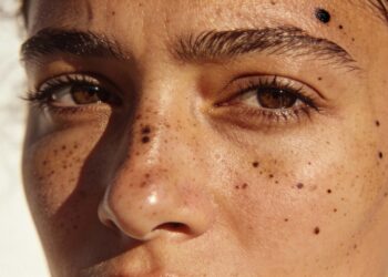 Manchas no rosto clareiam com esses tratamentos caseiros em 4 a 12 semanas de uso