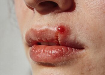 Espremer esse tipo de espinha é o pior erro que você pode cometer na pele