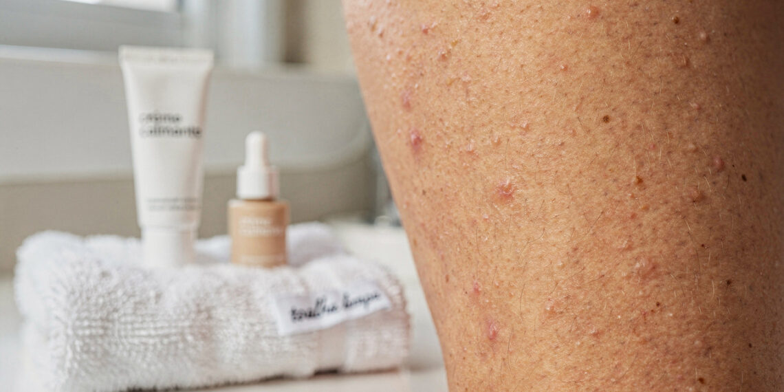 Por que surgem bolinhas vermelhas e coceira na região da virilha?