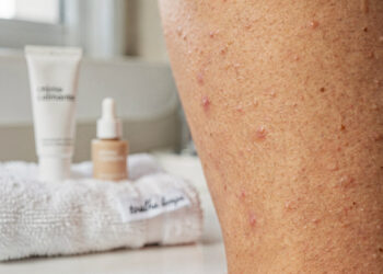 Por que surgem bolinhas vermelhas e coceira na região da virilha?