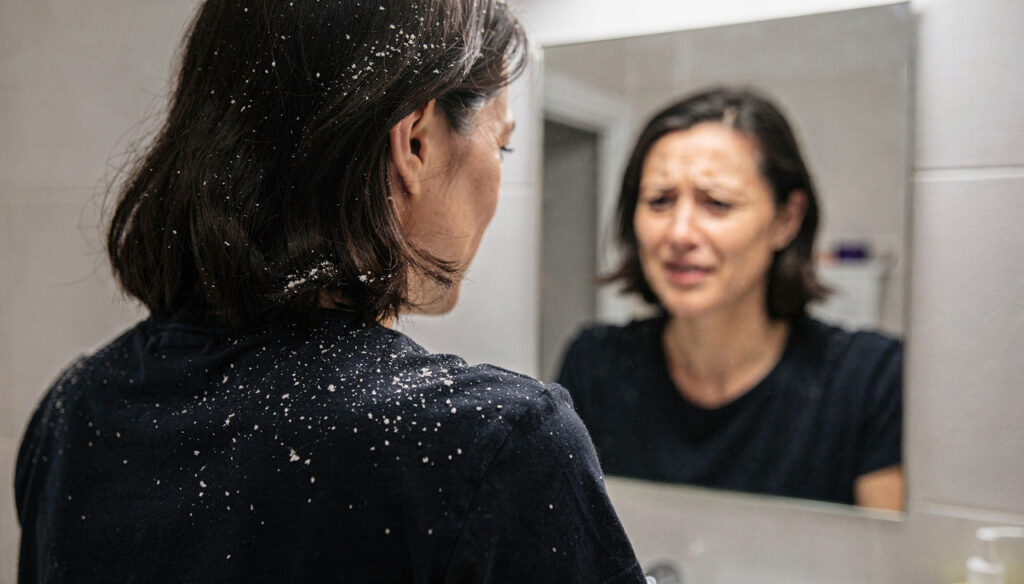 O que você faz todos os dias e pode estar piorando a sua caspa