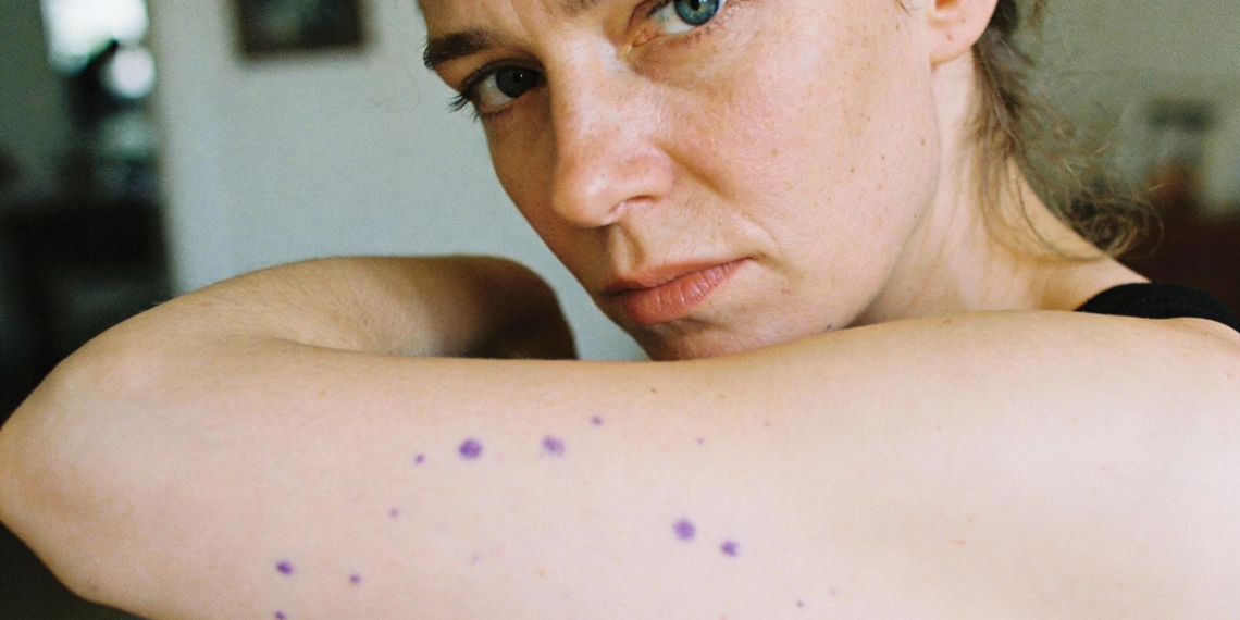 Manchas roxas na pele sem batida podem surgir quando o corpo entra em estresse constante