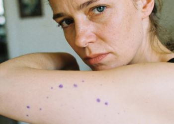 Manchas roxas na pele sem batida podem surgir quando o corpo entra em estresse constante