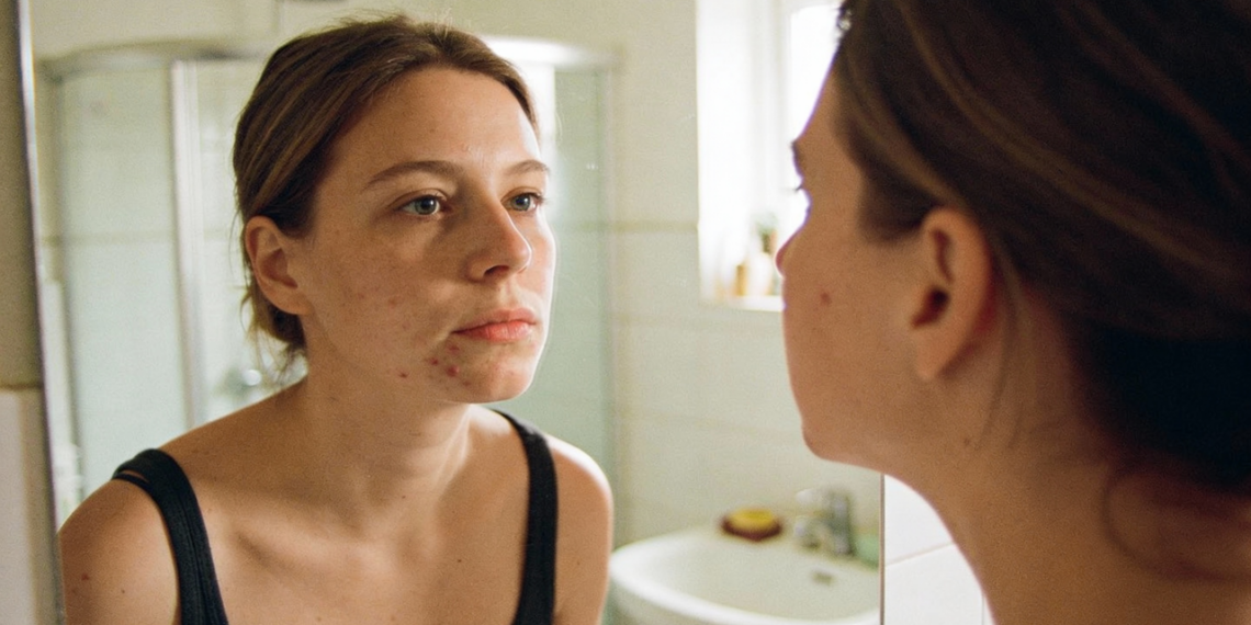 Saber identificar a acne certa muda totalmente o tratamento e evita danos maiores