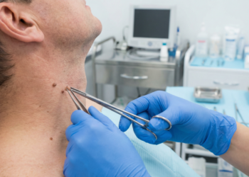 Verrugas do pescoço têm tratamento simples, mas exigem avaliação médica