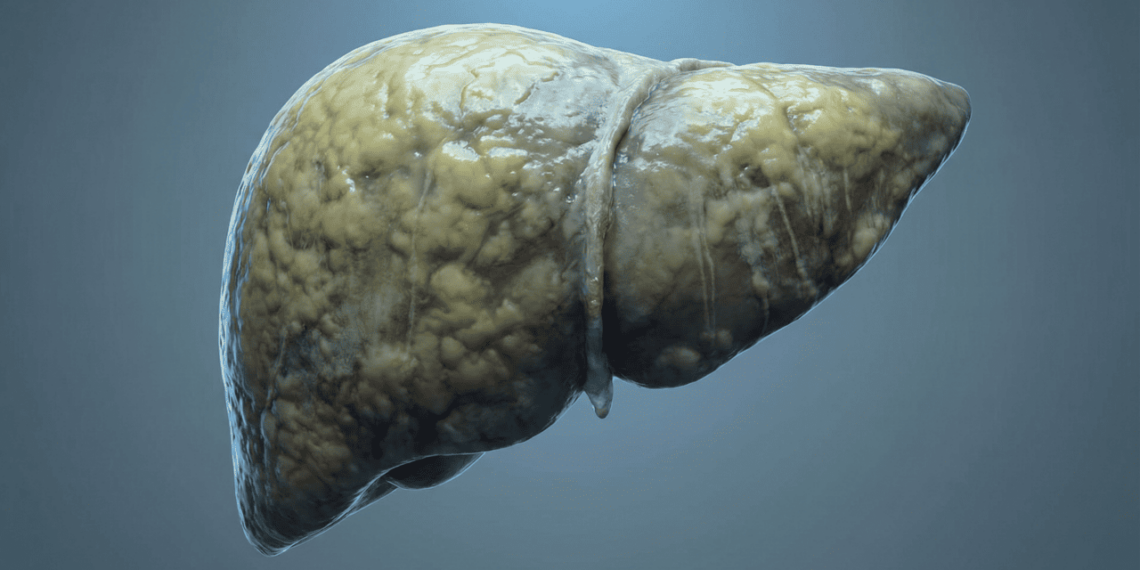 5 maneiras fáceis de se recuperar da esteatose hepática por conta própria