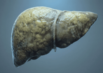 5 maneiras fáceis de se recuperar da esteatose hepática por conta própria