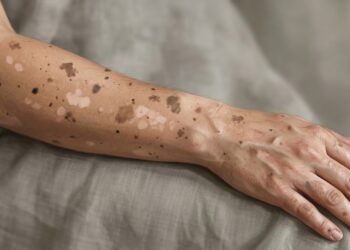 Manchas na pele que mudam de cor podem não ser algo simples e precisam de avaliação médica.