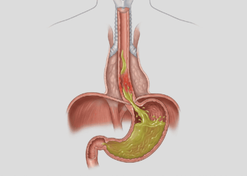 Azia não é apenas desconforto passageiro e os 3 estágios de dano ao esôfago explicam por quê