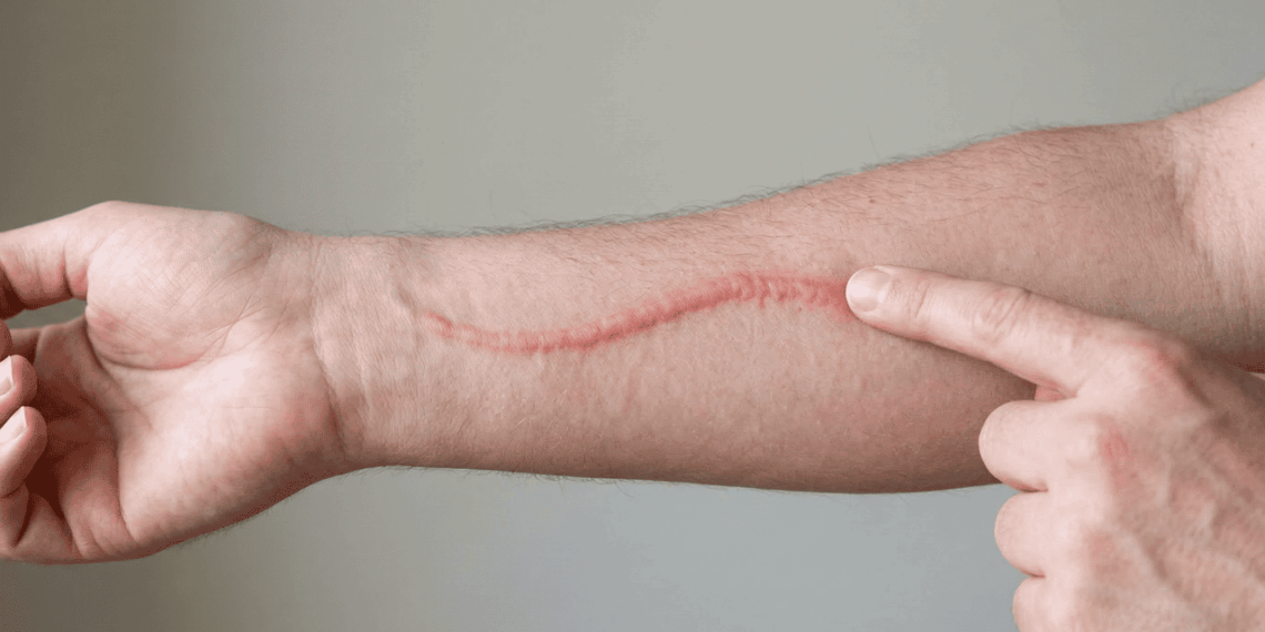 O que é dermografismo e por que a pele fica vermelha e inchada apenas ao ser riscada?