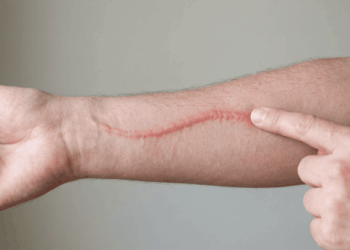 O que é dermografismo e por que a pele fica vermelha e inchada apenas ao ser riscada?