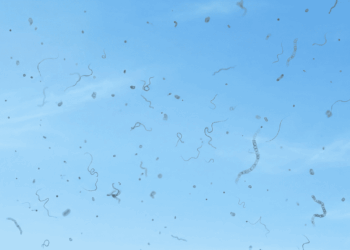 Você vê pequenos pontos ou fios flutuantes diante dos seus olhos? Essa pode ser a razão