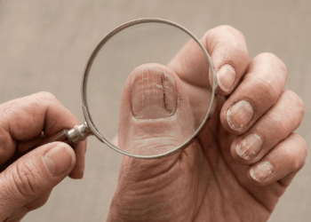 As unhas quebradiças e com linhas verticais estão de alguma forma ligadas a uma função metabólica crucial