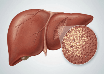 Como saber se tenho gordura no fígado? Aqui estão os sintomas e os exames