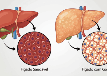 5 maneiras de proteger o fígado e reduzir o risco de esteatose hepática